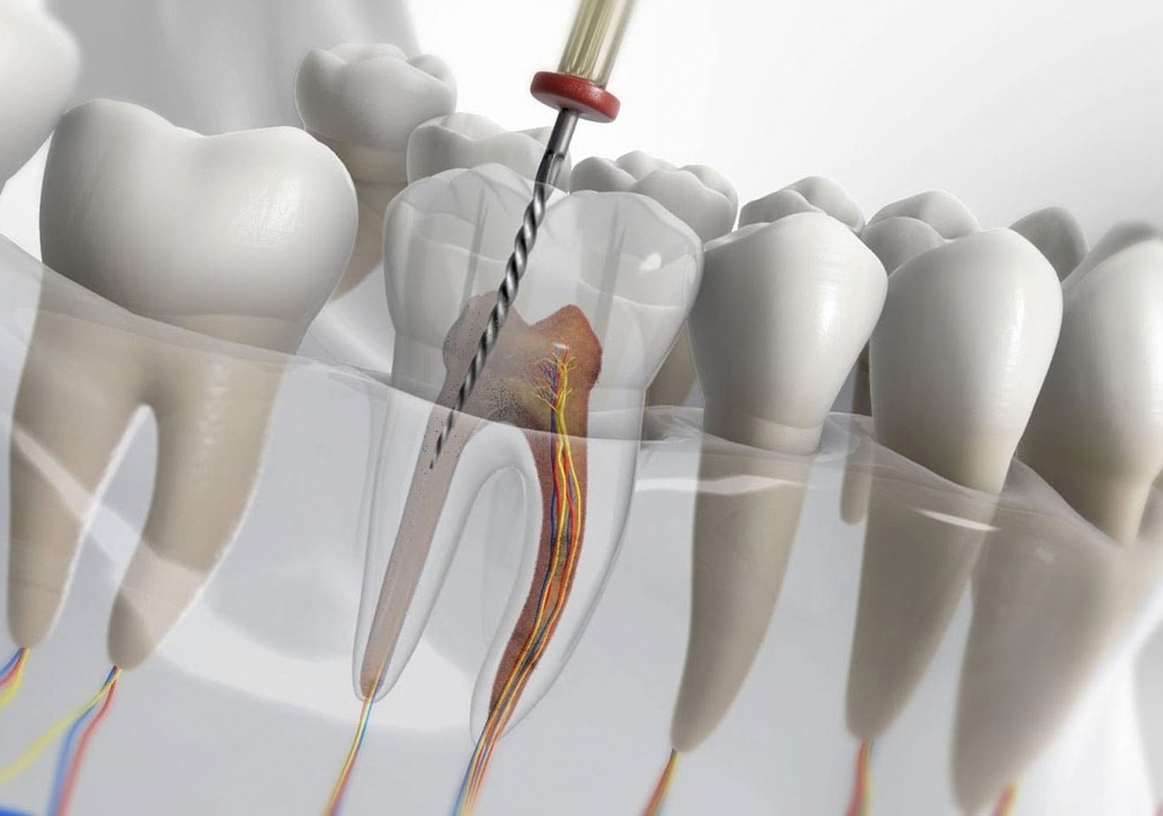 Kanal Tedavisi (Endodonti)
